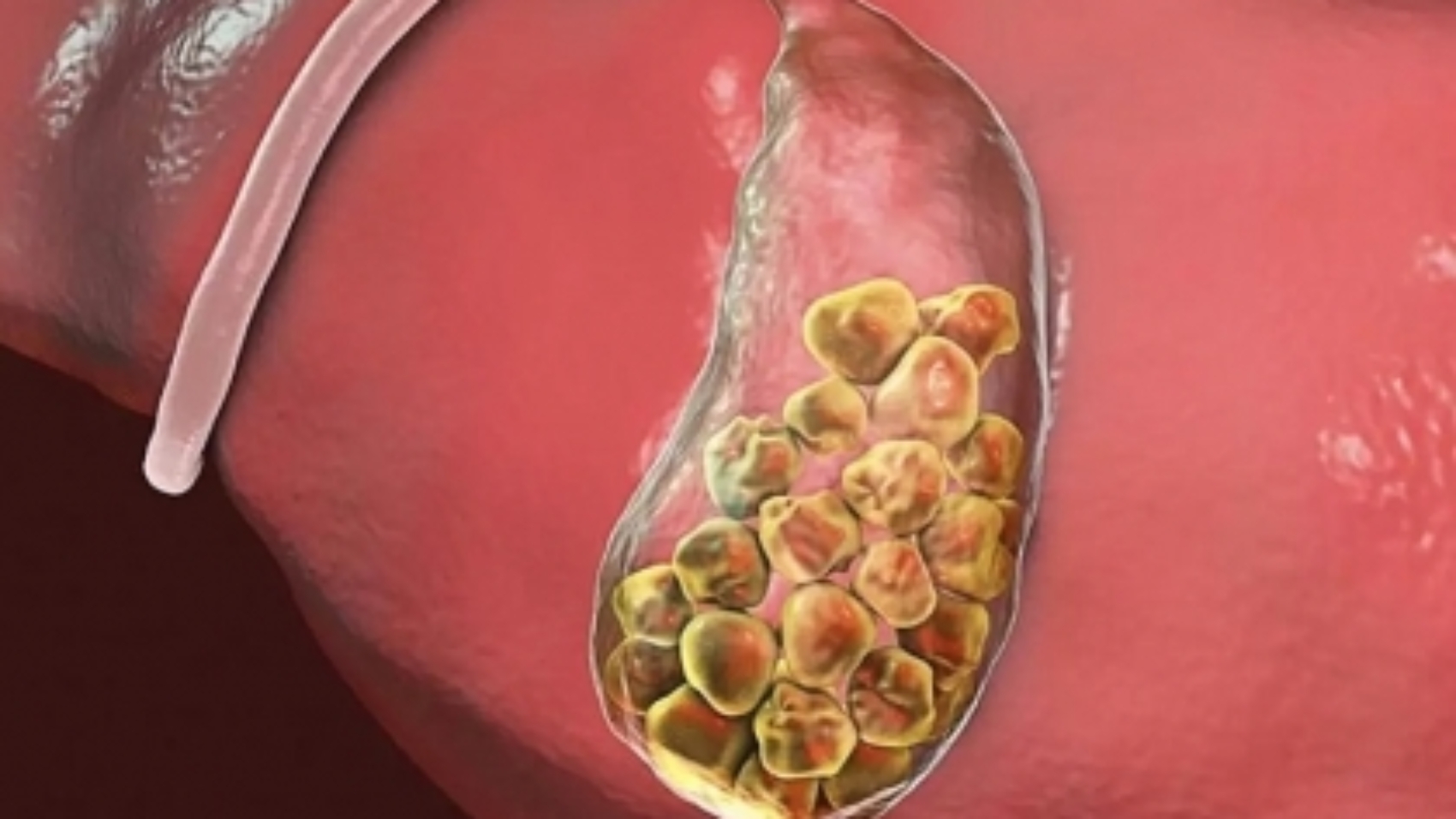 hazimsizligin-nedeni-safra-kesesi-olabilir