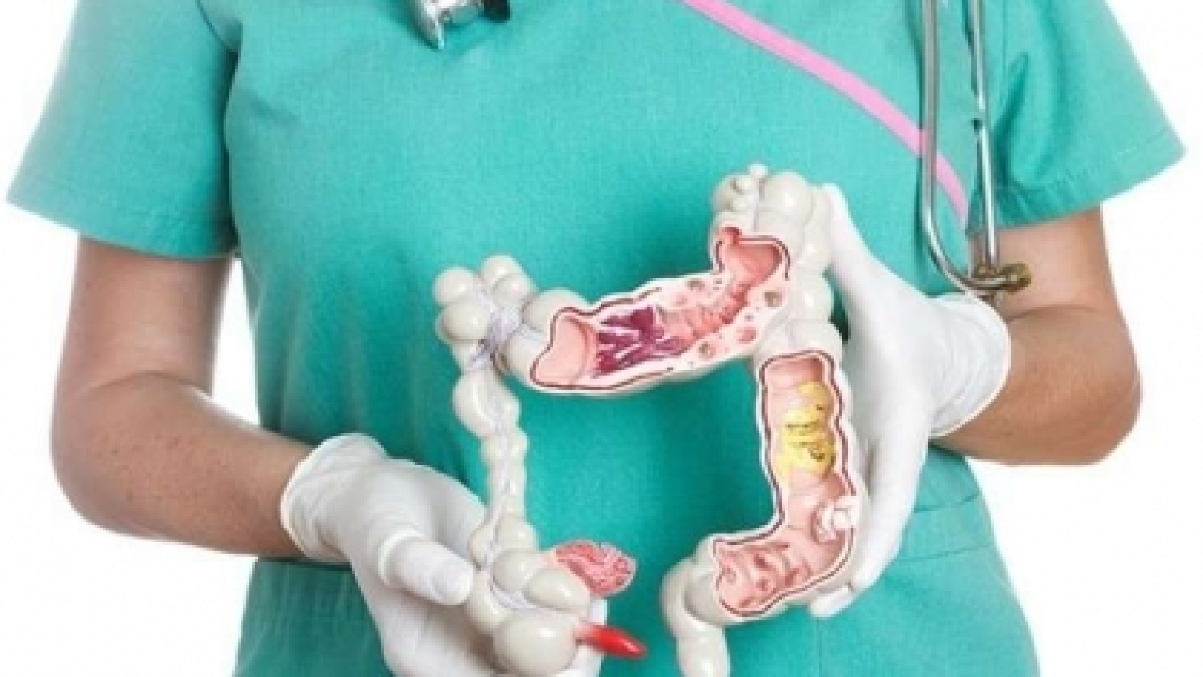 kolon-kalinbagirsak-kanseri